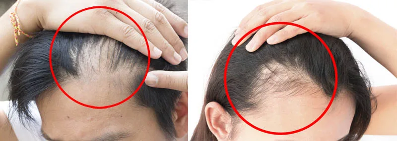 Tóc rụng nhiều là bị gì