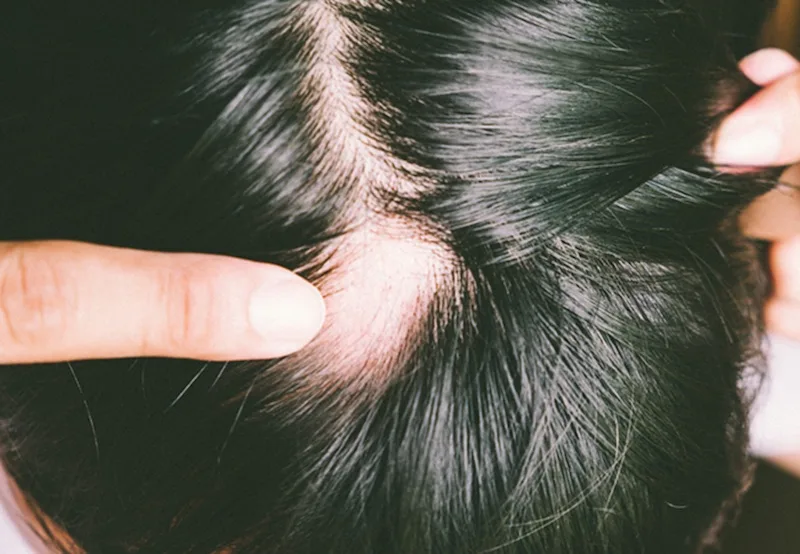 Tóc rụng nhiều là bị gì